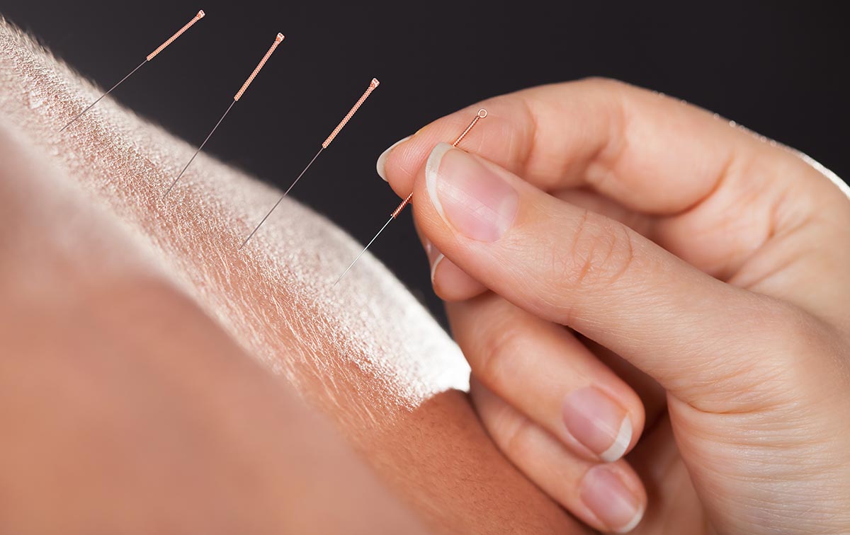 Acupuncture at Équanité clinic